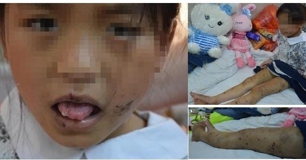 Bé gái 10 tuổi bị mẹ lấy kìm cắt lưỡi, tai vào ngày 1/6